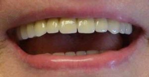 sourire-patiente-Dr-Garnier-dentiste-kremlin-Bicetre-avec-prothèse-dentaire-sur-implants