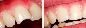 comment-réparer-dent-cassée--restauration-composite-dentaire