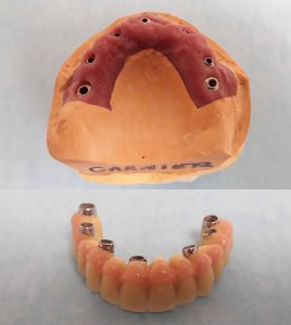 bridge-sur-implants-dentaires-Garnier-dentiste-KB